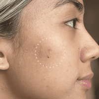 Mighty Patch™ for Dark Spots - Home Choice